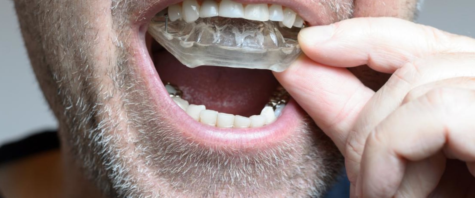 Do I Need to Have My Bite Checked Before Seeing a UK Orthodontist?