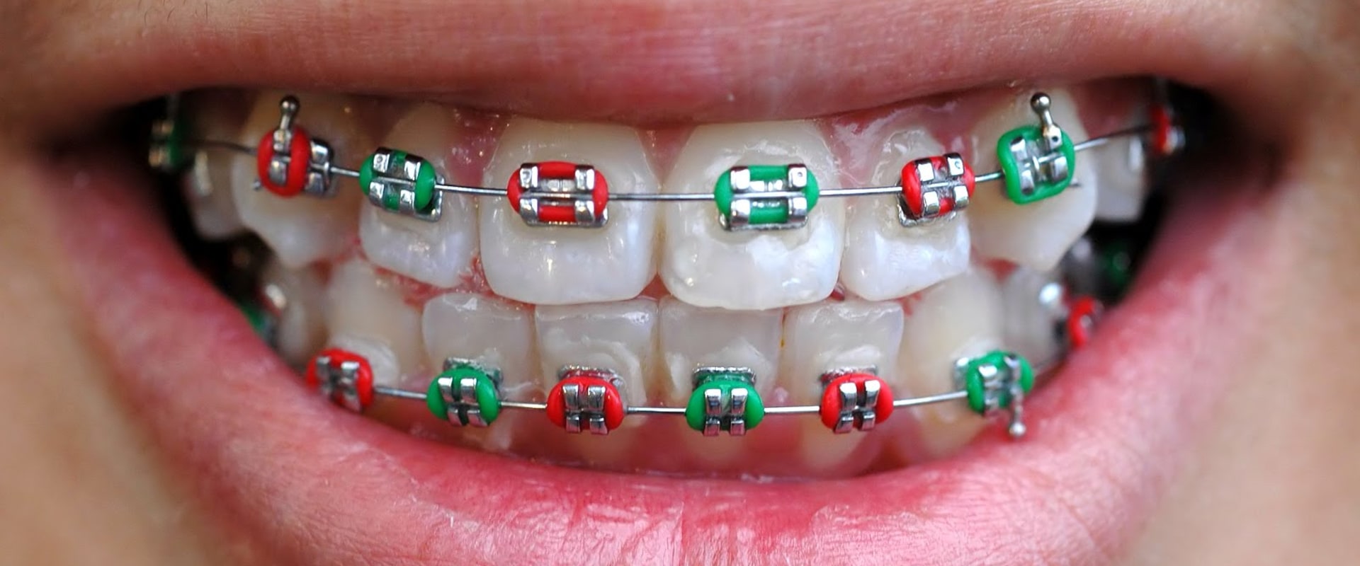 What Types of Materials are Used for Braces in the UK?
