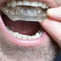 Do I Need to Have My Bite Checked Before Seeing a UK Orthodontist?