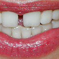Do I Need to Have My Gums Checked Before Seeing a UK Orthodontist?