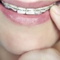 What is the Cost of Orthodontic Treatment in the UK?