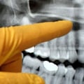Do I Need X-Rays Before Seeing a UK Orthodontist?