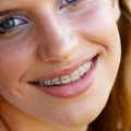 Aftercare for Orthodontic Treatment in the UK
