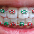What Types of Materials are Used for Braces in the UK?