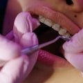 How Often Should You Have Your Braces Tightened by an Orthodontist?