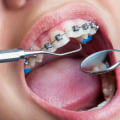 What Orthodontic Treatments Do UK Orthodontists Provide?