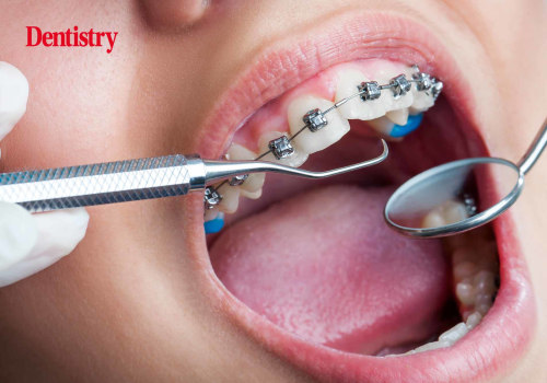 What Are the Risks of Orthodontic Treatment in the UK?