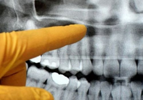 Do I Need X-Rays Before Seeing a UK Orthodontist?