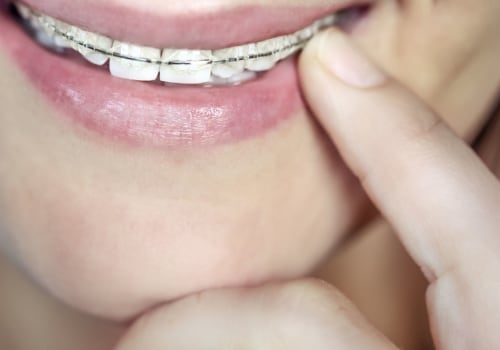How Much Does Orthodontic Treatment Cost for Under 18s in the UK?