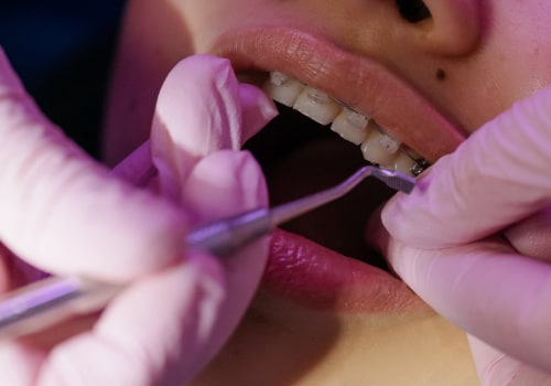 How Often Should You Have Your Braces Tightened by an Orthodontist?